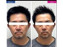 コリオ(KoRiO)/リフトアップ1回［狭山ヶ丘］