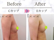 メディカルサロン エム エム エム 銀座プレミアムサロン(M.M.M.)/【バストアップ例】Ｃ→Ｅカップ