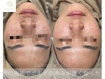 サロンドレナ 名駅店/ハーブピーリング サロンドレナ