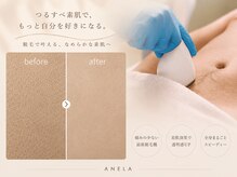 アネラ(ANELA)