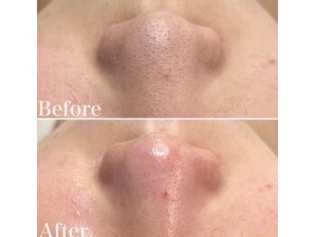 ビスイ 恵比寿(Bisui)/毛穴/毛穴洗浄/毛穴ケア