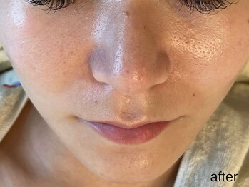 サロン ド エメ(salon de aimer)/【After】ふわふわ潤い艶肌へ♪