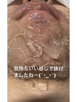 美容脱毛専門サロン エピラージュ 新宿店(Epilage)/痛みが少ないのにヒゲが爆抜け