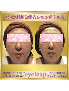 アイリープ(eyeleap)/☆脂肪分解剤【レモンボトル】