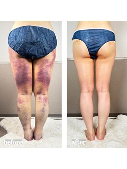 術後の女神 大阪心斎橋店/術後ケアインディバ・インディバ