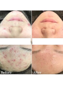 エステ ニキビケア研究所 川崎店/おでこニキビでお悩みの方へ!