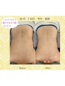 かれん/ハイパーナイフですっきり