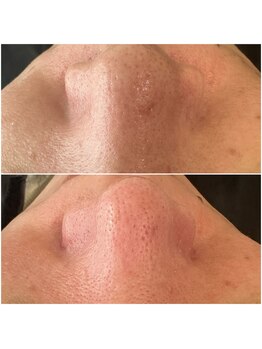 マヴィ 守口店(MavY.)/黒ずみ角栓スッキリ