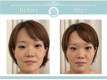 美人バスト 岡山店/【小顔コルギ症例】★