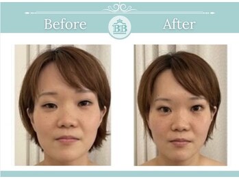 美人バスト 岡山店/【小顔コルギ症例】★