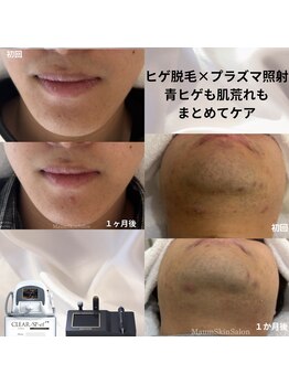 マウム(Maum)の写真/看護師監修◎ヒゲ脱毛で清潔感と自信を♪