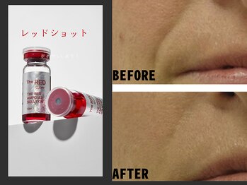 レミハ(Remiha)の写真/ほうれい線　たるみ・二重あごがきになる方へ引き締まりと肌の奥からハリを与え透明感のあるお肌へ☆