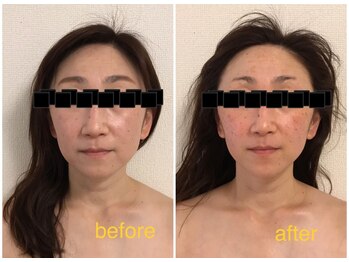 ココ(coco)/川越/たるみケア☆