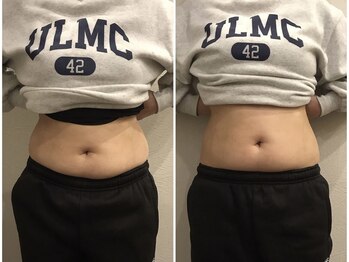 柏の葉オレンジ整体院/初回の変化☆スマートスカルプト