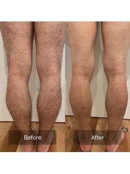 ルーチェ/【両脚脱毛】2回照射/2週間経過