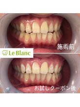 ルブラン 奈良店(Le Blanc)/黄ばみは蓄積していきます！