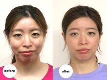 グランルーツ(GranRoots)/小顔矯正before/after