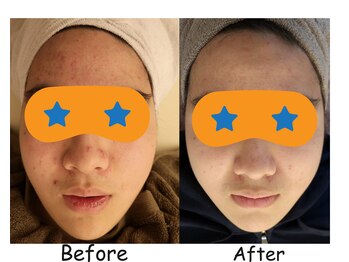 ふうき堂/ニキビケア！