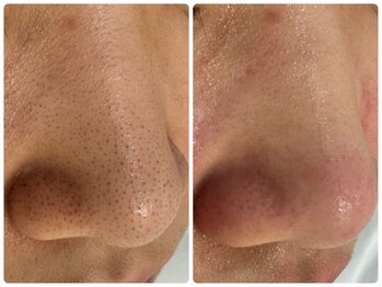 サイセイ(SAISEI)/オリジナル毛穴クリーン