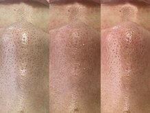 ソルシエール/韓国式3D毛穴洗浄