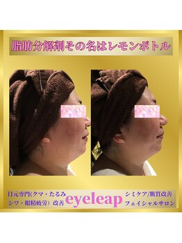 アイリープ(eyeleap)/☆脂肪分解剤【レモンボトル】