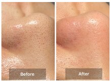 ステッラ(STELLA☆)/毛穴洗浄　Before/After