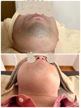 ティアレ 廿日市店(Tiare)/髭W打ち