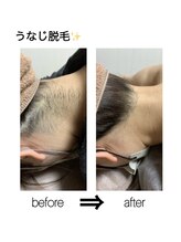 グリーディ 東山店(greedy)/うなじ脱毛