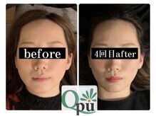 キュープ 富士店(Qpu)の雰囲気(エラボトの前にQpu富士店へご相談を!コリをほぐしてV字の輪郭へ)