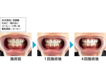 ルミナ(LUMINA)/営業マンこそホワイトニングを!