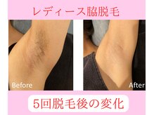 グロワール(gloire)/レディース脇脱毛BeforeAfter