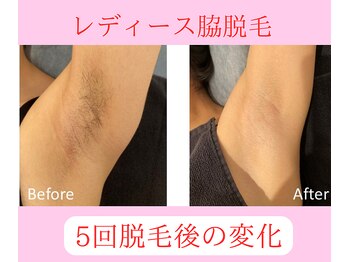 グロワール(gloire)/レディース脇脱毛BeforeAfter