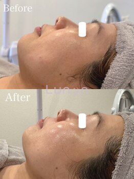 ルノン(Lunon)/毛穴洗浄ハイドロ×ララピール