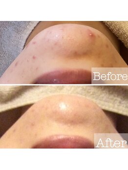 パウザ(PAUSA)/ハーブピーリング当店実績