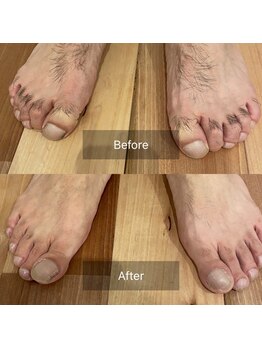 ルーチェ/【脱毛箇所】足の甲、足の指