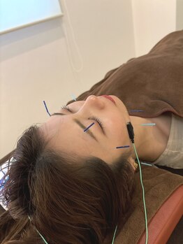 ハリファ鍼灸院 熊本院(HariFa鍼灸院)/効果が実感できる美容鍼を体験