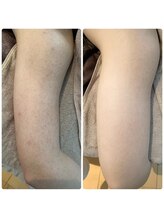 ルアナアイナ(Luana Aina)/二の腕ケア/ハーブピーリング