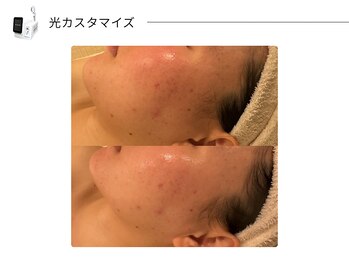 スパレーカ(Spa laka)/光カスタマイズ