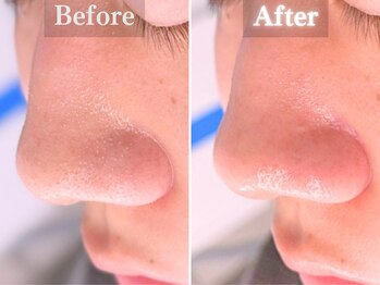 ボーンオム(Born Homme)/毛穴洗浄+美容液導入:20代男性