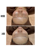 トータルビューティーサロン ヴィヴィエ(ViVier)/ララピール×ニキビ