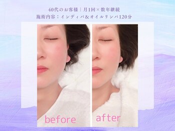 サロン タエン/小顔＆リフトアップ！インディバ