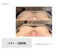 【光エステ】バストケア¥5,000　