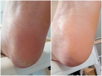 アンティ(Aunty)/かかとの白く逆立つガサガサ肌