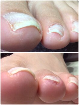 モアクリスタル(More Crystal)/巻き爪補正