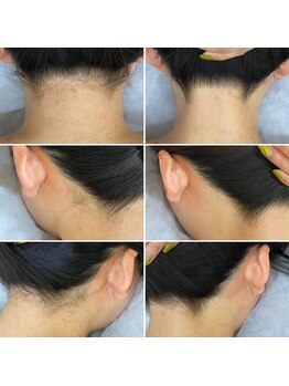 インベスト(INVEST)/うなじ脱毛