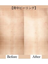 キヨカ(kiyoka)/ハーブピーリングBefore After