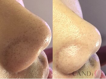 キャンディ 難波心斎橋店(CANDi)/ハイドラピーリング/黒ずみ毛穴
