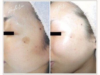 ミューベル(MYubelle)/シミ改善美白 水光ピーリング