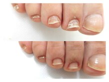 巻き爪ケアサポート ルアナ(LUANA)/Before↓After