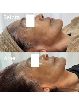 エー(A)/ビフォーアフター